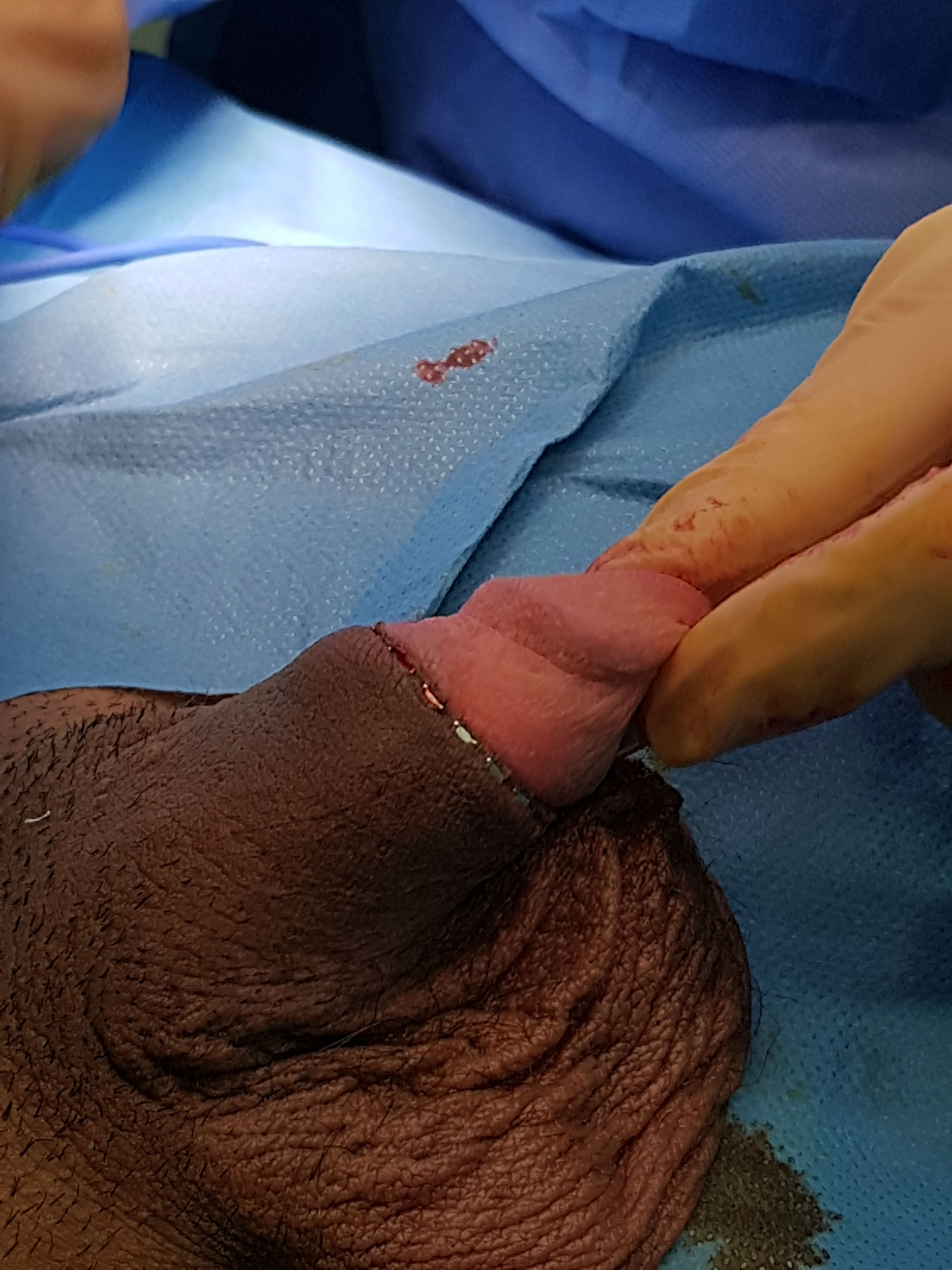 15-year-old french phimosis patient-4.jpg